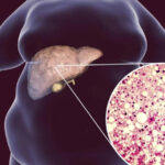 Jejum intermitente pode reduzir a gordura no fígado? O que dizem os estudos científicos