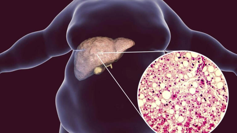 Jejum intermitente pode reduzir a gordura no fígado? O que dizem os estudos científicos