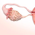 Síndrome dos Ovários Policísticos: o distúrbio silencioso que afeta o ciclo feminino